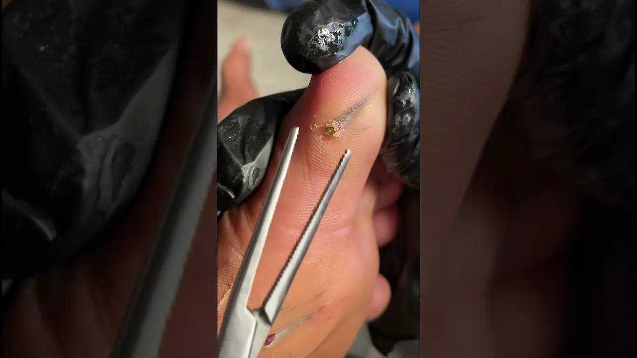 Thorn remove