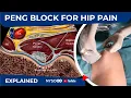 PENG BLOCK FOR HIP PAIN - NYSORA's Regional Anesthesia Clinical Cases