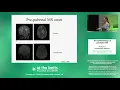 Professor Emmanuelle Waubant - The epidemiology of paediatric MS