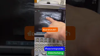  อาการบวมแดงร้อนที่ข้อเข่าเกิดจากสาเหตุอะไรบ้าง 