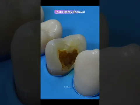 How to remove tooth decay?  #dentist