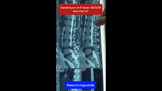  หมอนรองกระดูกเคลื่อนออกมามีผลต่อร่างกายอย่างไรบ้าง 