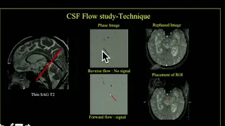 TMT CSF Flow Studies Part IV Normal Pressure Hydrocephalus 