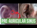 Explaining a preauricular sinus a tiny hole in front of the ear what happens when it s infected
