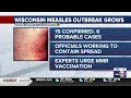 Measles cases surge to 15 in Iowa and Lafayette counties as Wisconsin warns of more spread