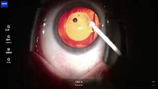 04 ICL l00p5 260826