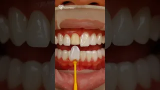 قشور الفينير لا تحتاج لنحت السن كاملا فينير الاسنان Dental Veneers 