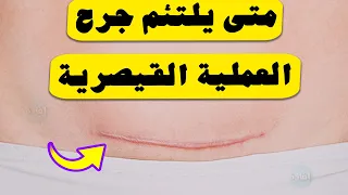 متى يلتئم جرح العملية القيصرية 