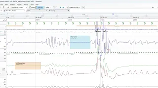 Noxturnal Single-Click Scoring