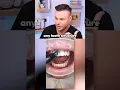Download Lagu When Getting Veneers Goes WRONG! 😭🦷