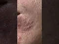 BLACKHEAD