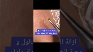 طريقه صحيه لزاله الشامات بليزر وبدون أي أثر او ألم شاهد الفيديو 