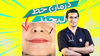 بهترین روش های درمان خط خنده HOW TO SMOOTH YOUR SMILE LINES 