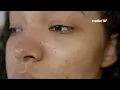 Download Lagu ELAK GUNA SKINCARE LEPAS BEKAM WAJAH | Imedikel TV