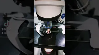 UTI Under The Microscope Urinary Tract Infection PUS Cells White Blood Cells Laboratory Urine Mt 