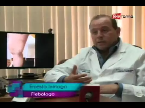 Varices en las piernas ¿Cómo tratarlas?