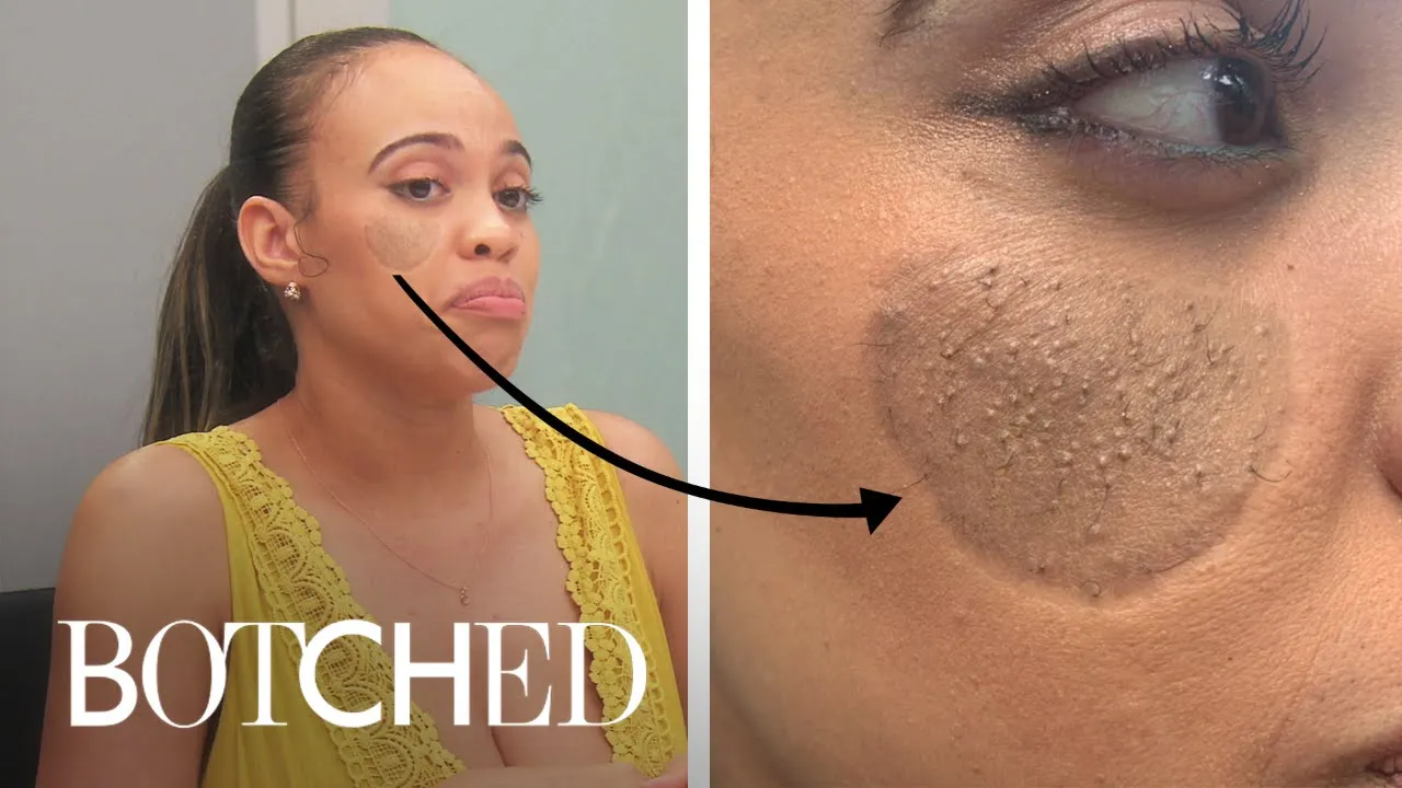 Dog Bite Victim Has "Pubic Hair" Growing on Her Face | Botched | E!