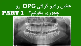 رادیو گرافی پانورامیک  اوپی جی   رو چجوری بخونیم  تحلیل  تفسیر و بررسی کامل   قسمت اول        دندنها