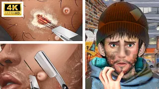 ASMR You Can Feel – Popping & Pulling Ingrown Hairs in 4k