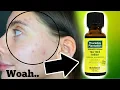 I TESTED TEA TREE OIL ON MY PIMPLES FOR ONE WEEK DOES THIS WORK
