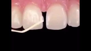                   طريقة اغلاق الفلجة بين الأسنان دندنها