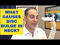 What Causes Bulging Disc In Neck CERVICAL DISC BULGE Dr Walter Salubro Chiropractor in Vaughan
