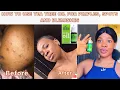 HOW TO TREAT ACNE - REMOVE PIMPLES and Blemishes Tea tree oil for acne