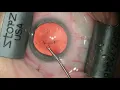 Download Lagu Aventa and Spyglass  - Surgery 2/23/21