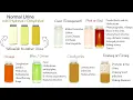 Download Lagu Understanding Urine Color.  Foamy urine, Dark Urine, Red Urine,  Green Urine, Cloudy Urine