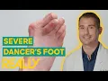 Download Lagu Dr. Brad Revisits The Worst Case Of Dancer’s Feet He’s Ever Seen | My Feet Are Killing Me