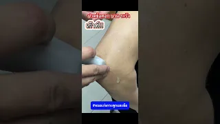  อาการเจ็บข้อศอกและบวมที่เกิดขึ้นอย่างฉับพลัน มีสาเหตุมาจากอะไร 