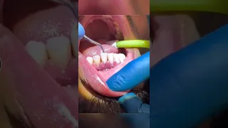 إزالة جير الاسنان من تحت اللثه 