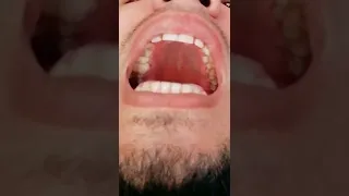 نطق الراء المرققة والمفخمة بتصوير قريب يظهر الفجوة التي برأس اللسان التي تمنع التكرار الزائد للحرف 