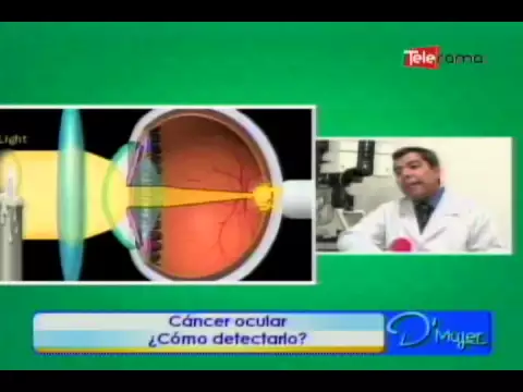 Cáncer ocular ¿cómo detectarlo?