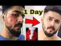 Download Lagu Pimples Kyu Hote hai ? pimple Kaise Thik Kare | Remove Pimples #hunkharsh #pimples #acne #skin