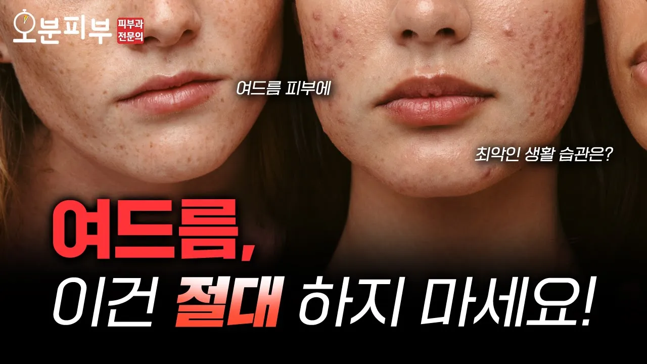 절대 하지 마세요! 여드름 피부에 안좋은 생활 습관