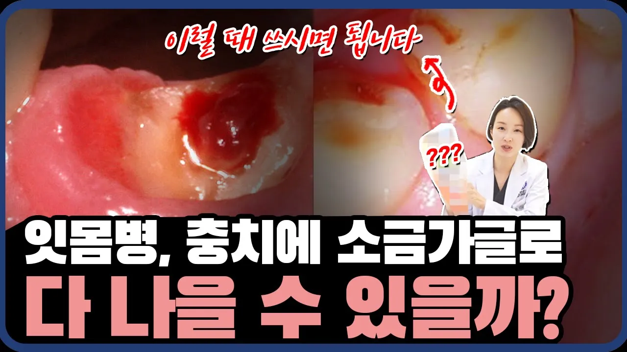 ()잇몸 붓기, 충치에 효과있는 소금물 가글 쓰는법ㅣ 치과 원장이 알려드립니다. #충치 #잇몸질환 #잇몸병 #치아건강