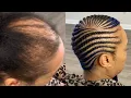 PART TWO Lemonade Feed In Braids on a Client with Alopecia