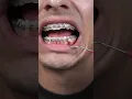 Removing buildup from braces