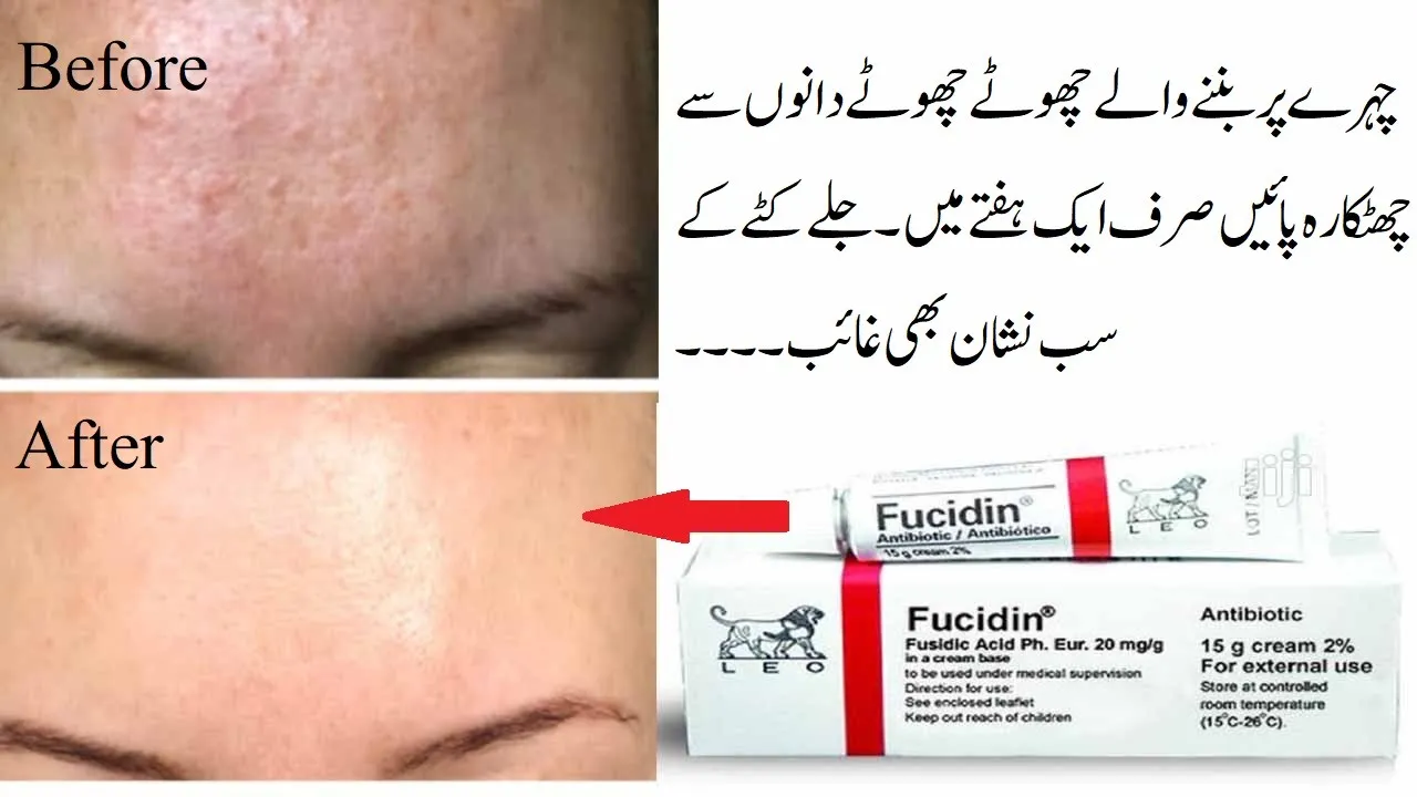 This video has complete information on Fucidin cream, uses , contraindications, how to use.. 