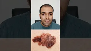 کدام یک از خال های پوستی ت ممکنه سرطانی باشه و دیر بفهمی 