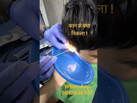 Foreign Body Removed from Child’s Ear | Endoscopic Examination 👂 #shorts #neet #cockroachjantaparty
