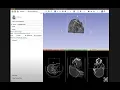 Cropping a Volume 3D Slicer Workflow