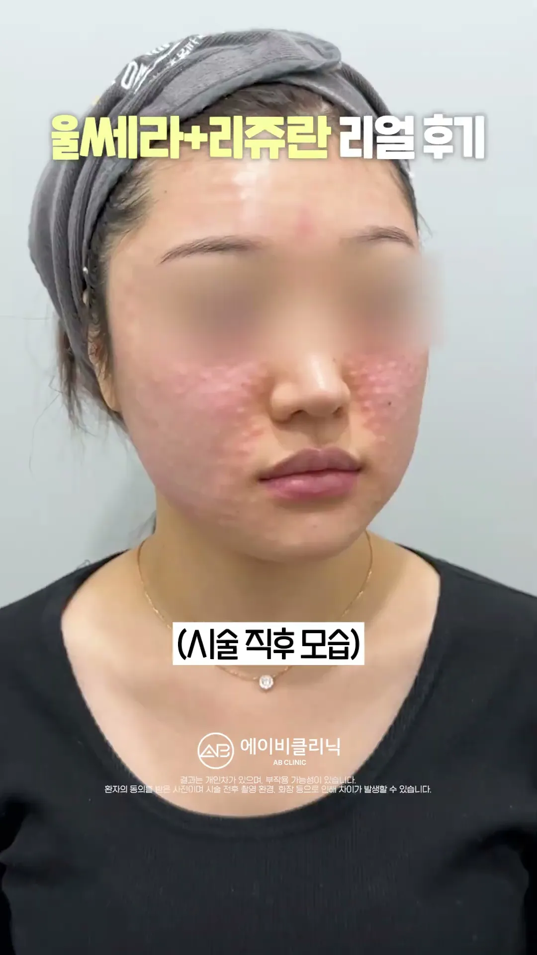 울쎄라+리쥬란 리얼 후기!