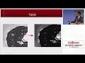 Treatment Strategy for Ground Glass Opacity and Tiny Lung Nodules