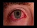 Eye Complaints in Urgent Care Medicine