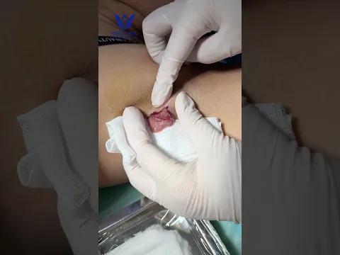 Nặn mụn nhọt áp xe Nách