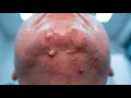 Loan Nguyen Acne Treatment 26zz