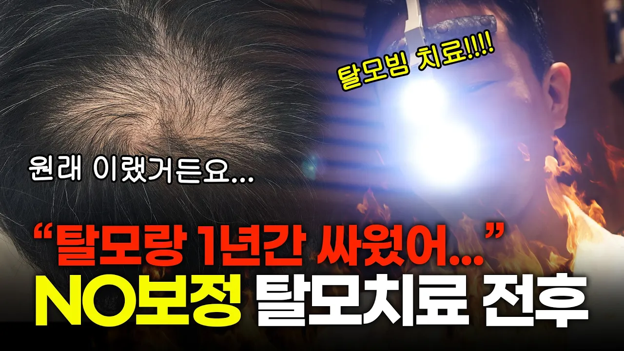 완전 NO 보정 탈모치료 1년 전후