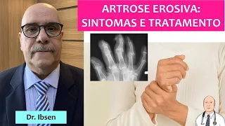 O que é artrose erosiva? Dores nos dedos das mãos com grande inflamação e destruição das juntas